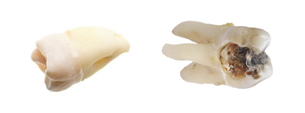 Extracted teeth examples