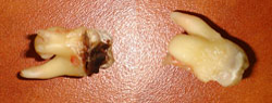 Extracted teeth