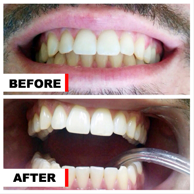 Before and after teeth whitening
