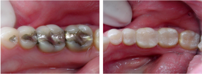 Before and after dental fillings