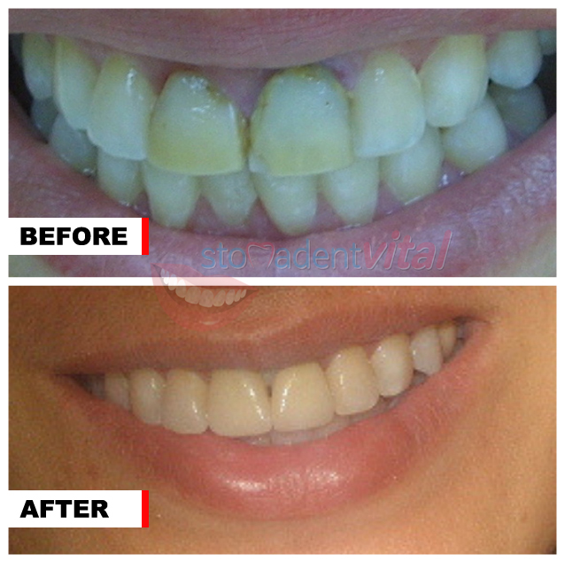 Before and after crowns
