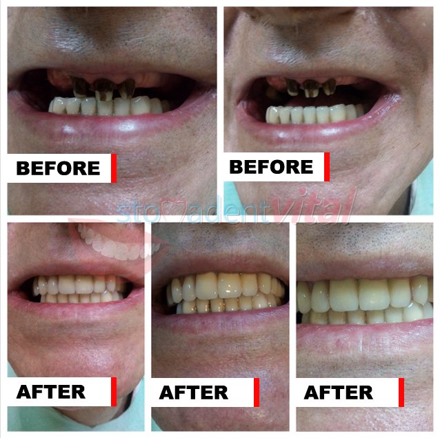Before and after fixed prosthetics