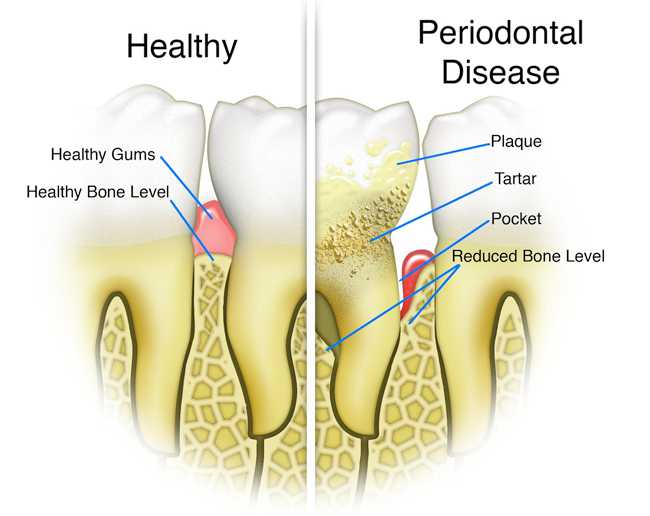 Healthy and periodontal disease