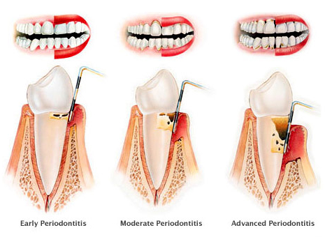Stages of periodontitis