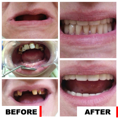 Before and after mobile prosthetics