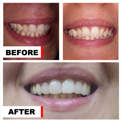 Before and after porcelain veneers