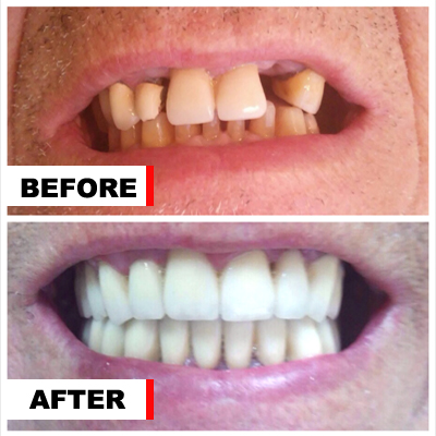 Before and after dental bridges case one